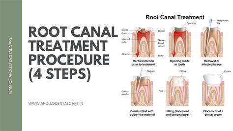 how to stop a root chanel|Root Canal: Procedure, What It Treats .